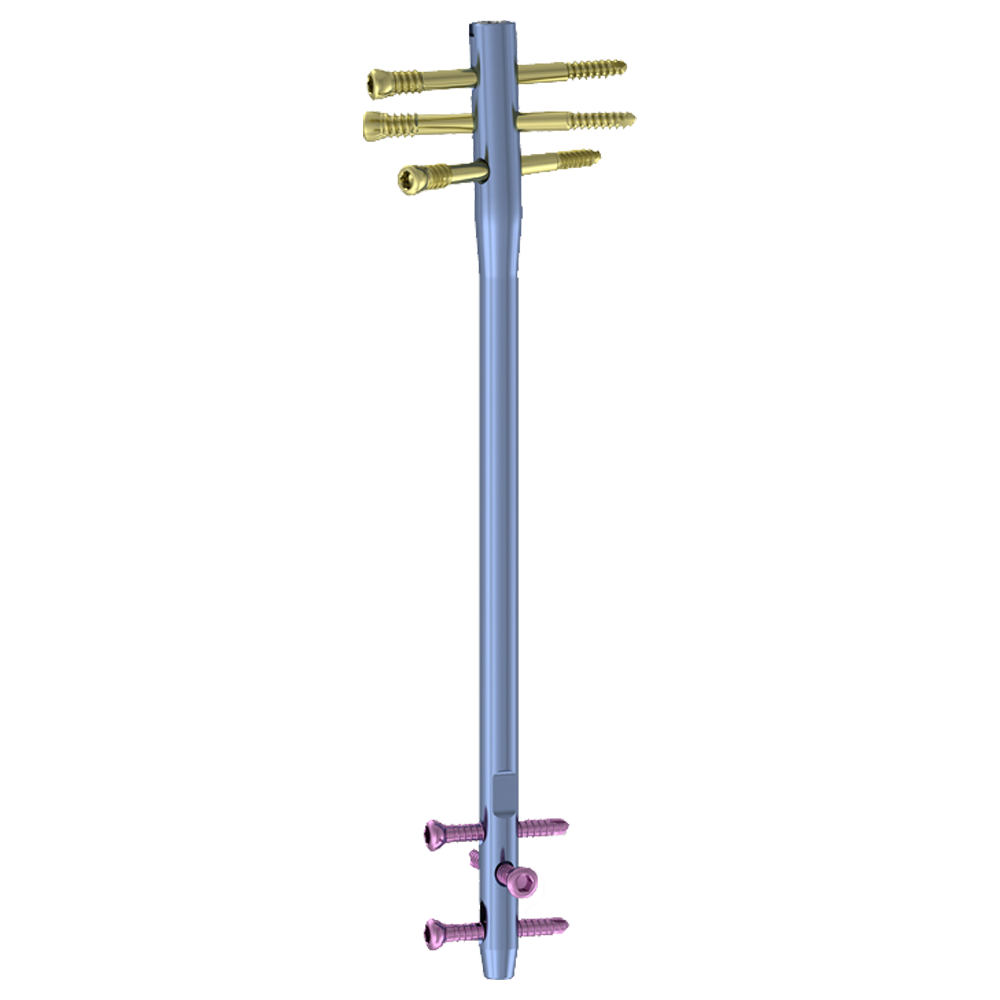 Femoral Reverse Interlocking Nail System