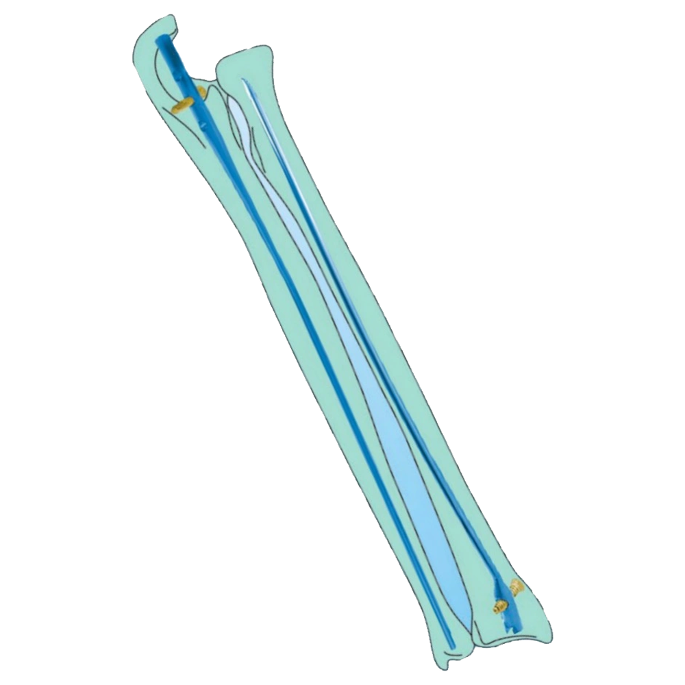 Ulna Radius Interlocking IM Nail Implants