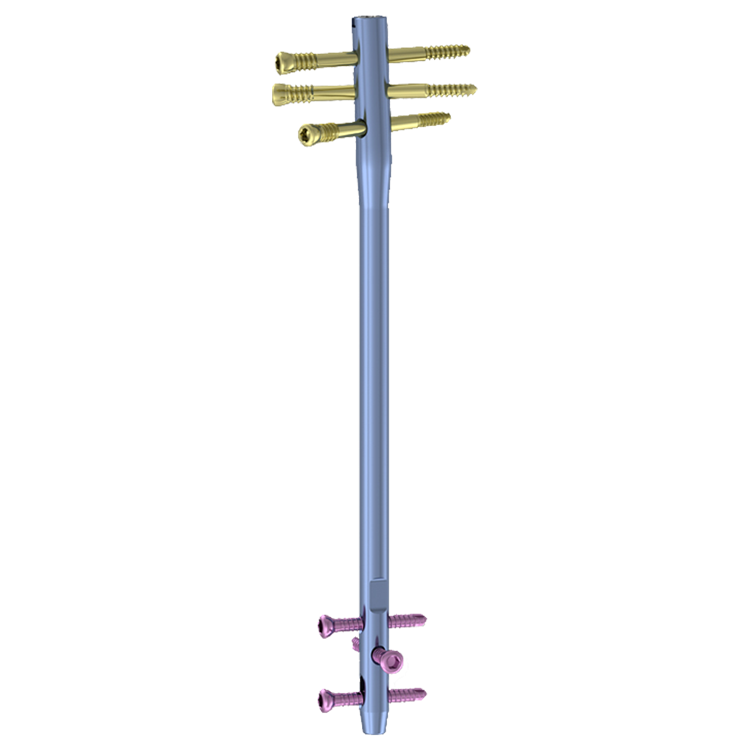 Femoral Reverse Interlocking Nail System