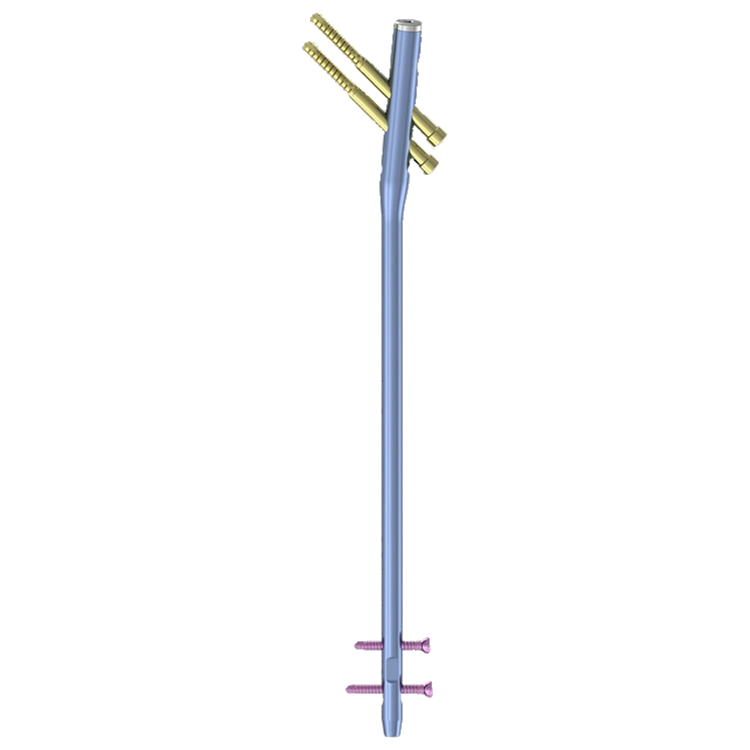 Humeral proximal locking nail bundle