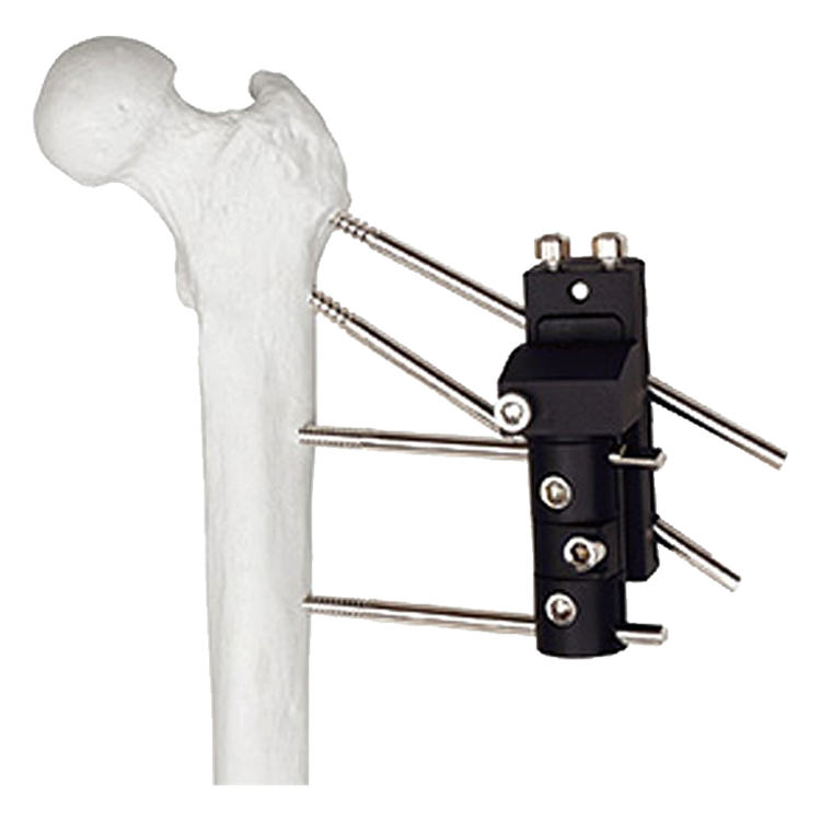 Pertrochanteric external fixator