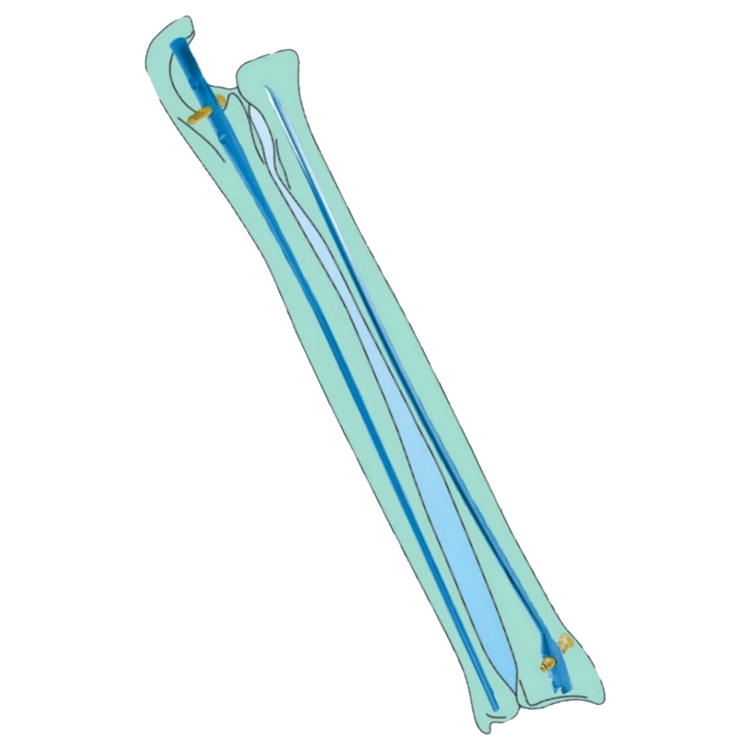 Ulna radius IM nail implants